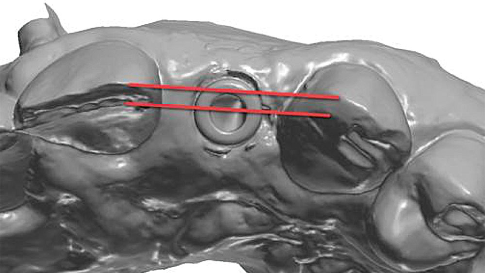 screw-retained implant restoration is designed