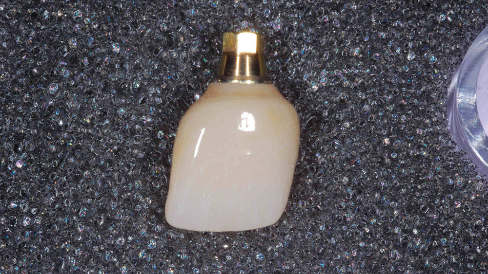 a milled screw-retained restoration