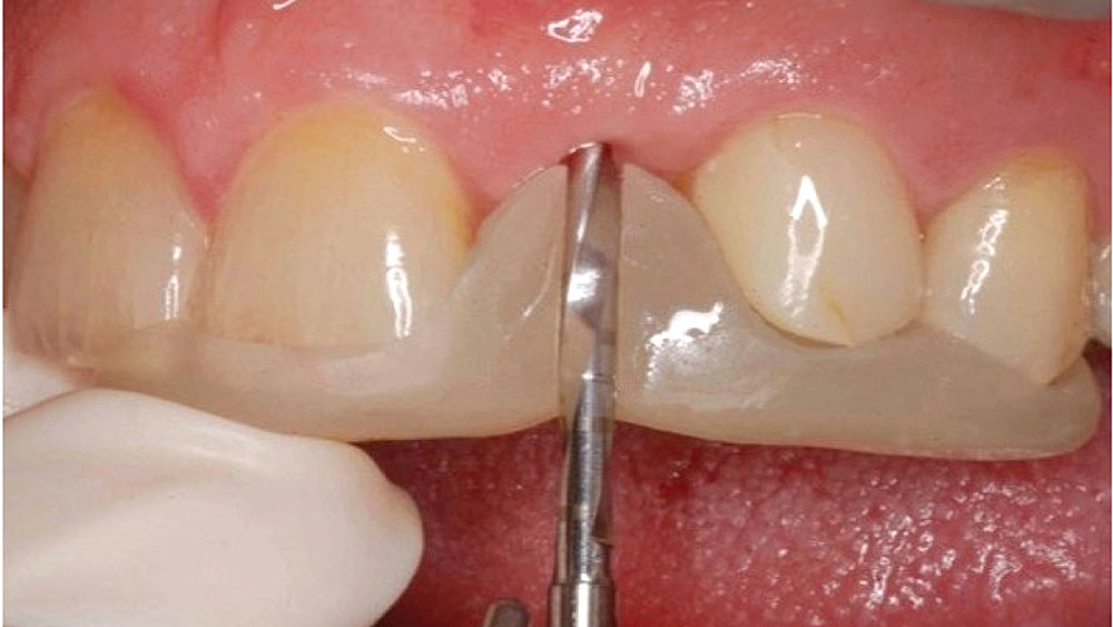 2 mm pilot drill was used to create the initial osteotomy through a non-digital surgical template