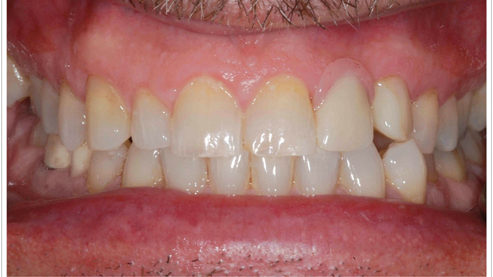 During the healing phase of treatment, the patient wore an interim flipper with an ovate pontic design to intiate soft-tissue development