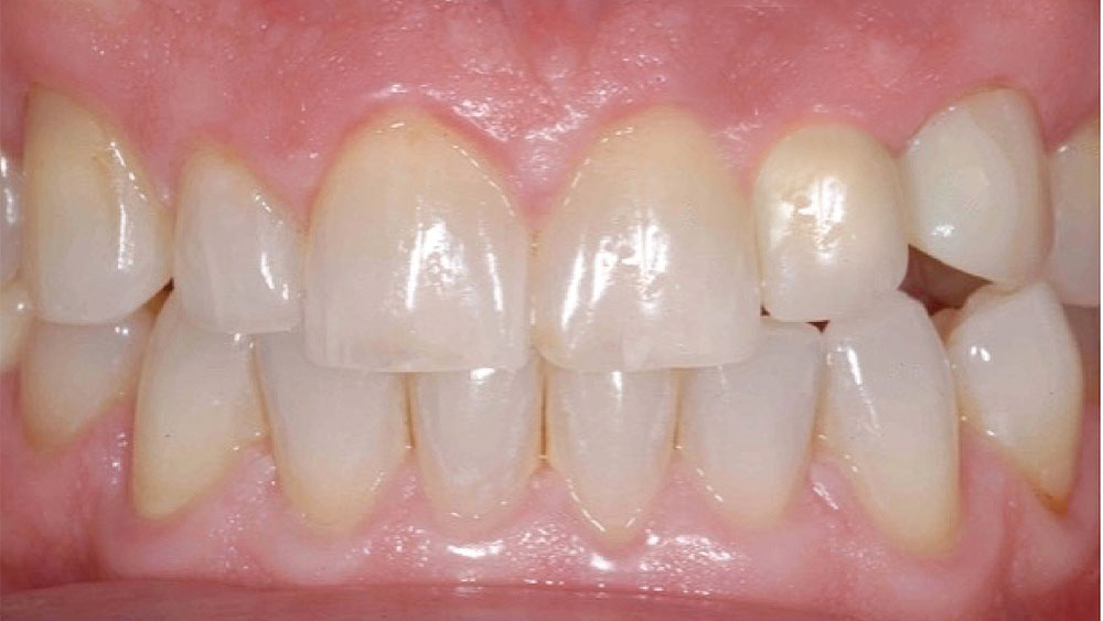 A digital impression was created using a TRIOS® intraoral scanner (3Shape North America; Warren, N.J.) and a Hahn Scanning Abutment (Glidewell Direct)