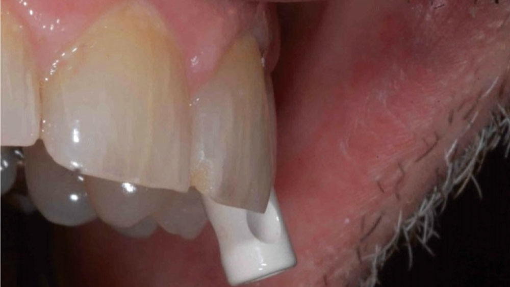 A digital impression was created using a TRIOS® intraoral scanner (3Shape North America; Warren, N.J.) and a Hahn Scanning Abutment (Glidewell Direct)