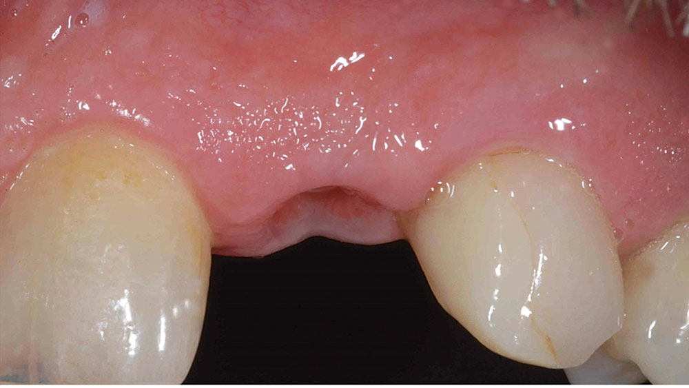 thick soft tissue surrounding implant site