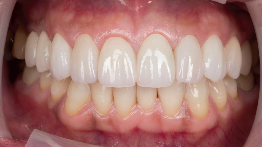 Final BruxZir Esthetic crowns and Vivaneer™ BruxZir Esthetic Veneers