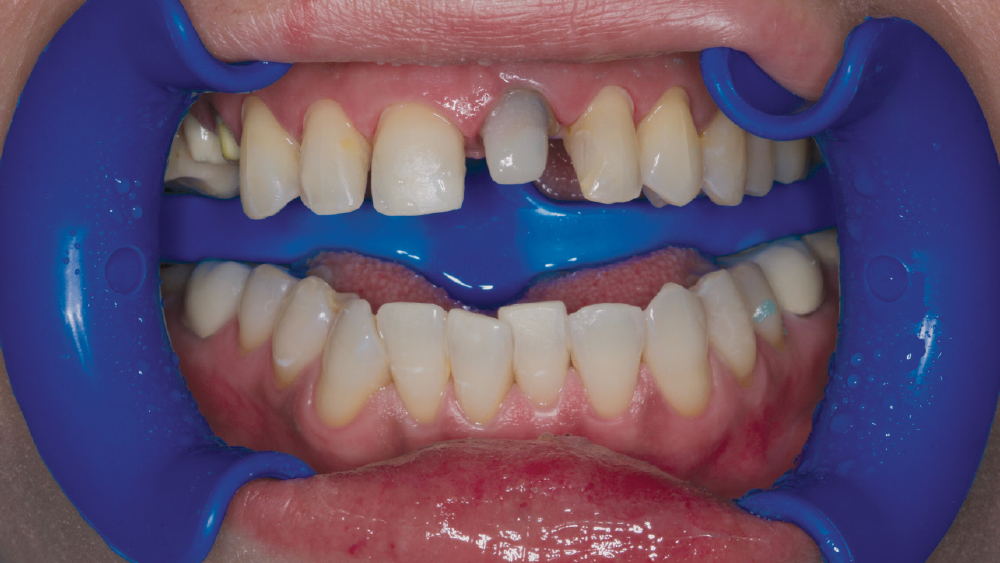 external bleaching on the preparation