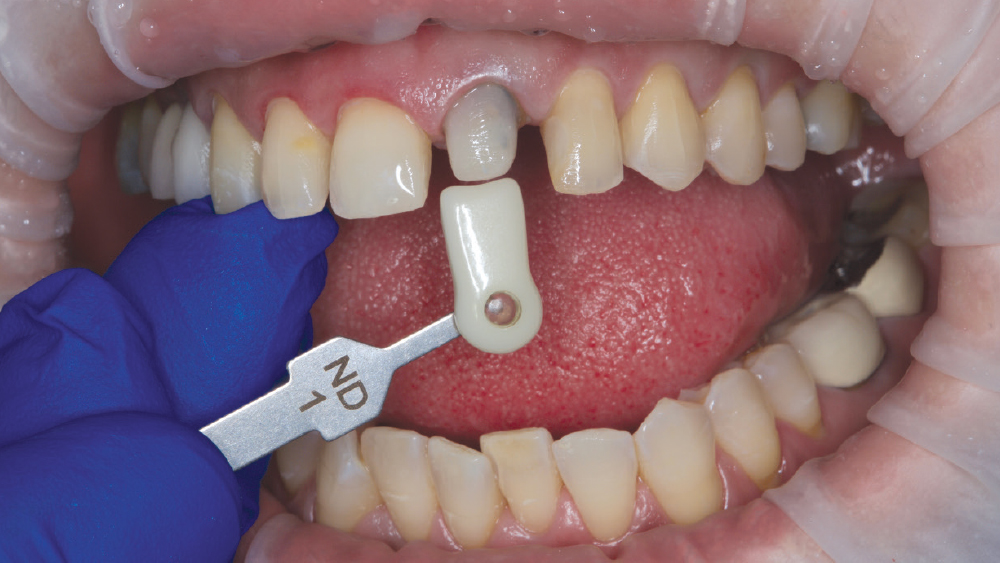 VITA 3D-MASTER® shade 3M3 to a bleach shade