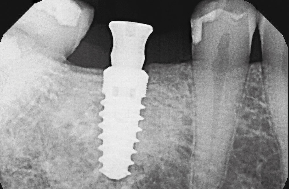 cm1401-rd-corner-efficacy-hahn-tapered-system-7a