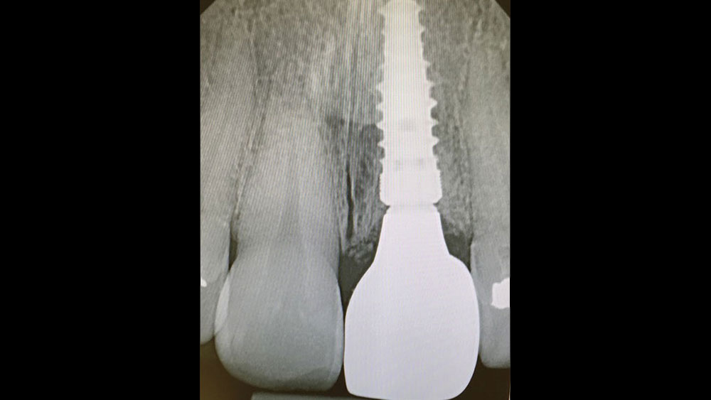 cm1401-rd-corner-efficacy-hahn-tapered-system-9c