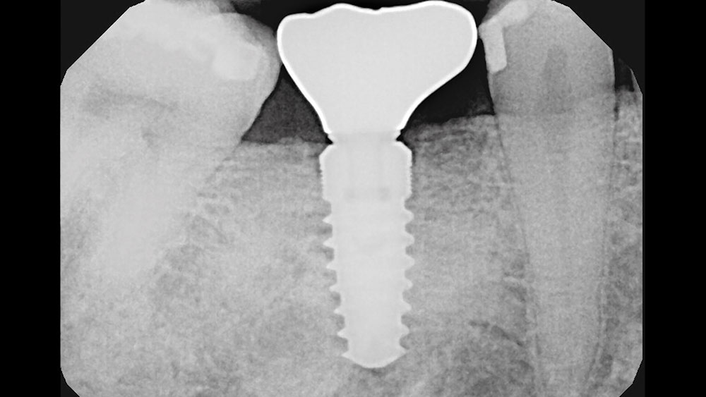 cm1401-rd-corner-efficacy-hahn-tapered-system-7b