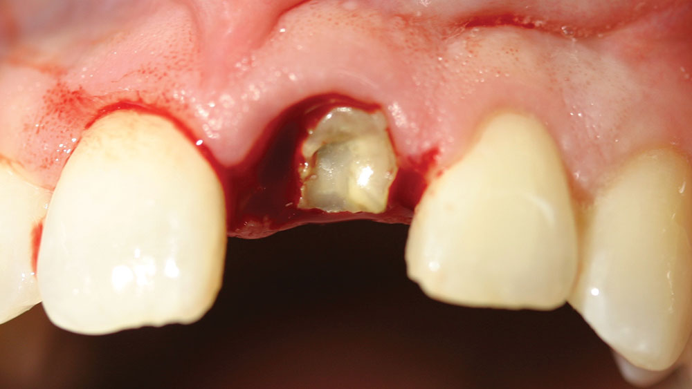 cm1401-rd-corner-efficacy-hahn-tapered-system-9a