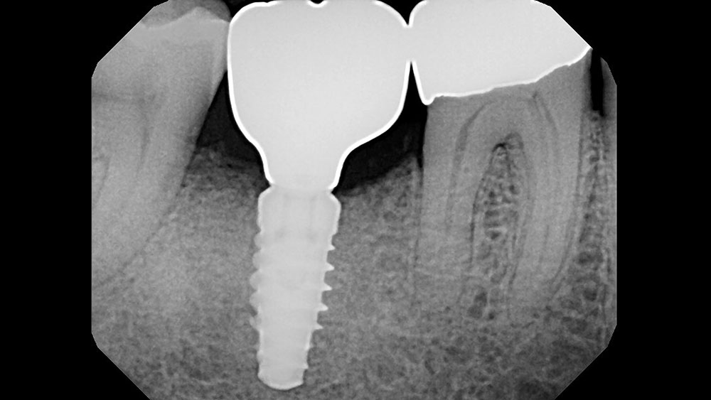 cm1401-rd-corner-efficacy-hahn-tapered-system-8b