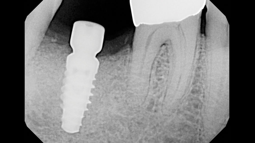 cm1401-rd-corner-efficacy-hahn-tapered-system-8a