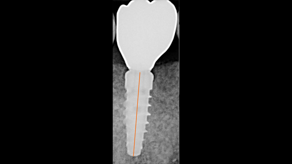 cm1401-rd-corner-efficacy-hahn-tapered-system-1a