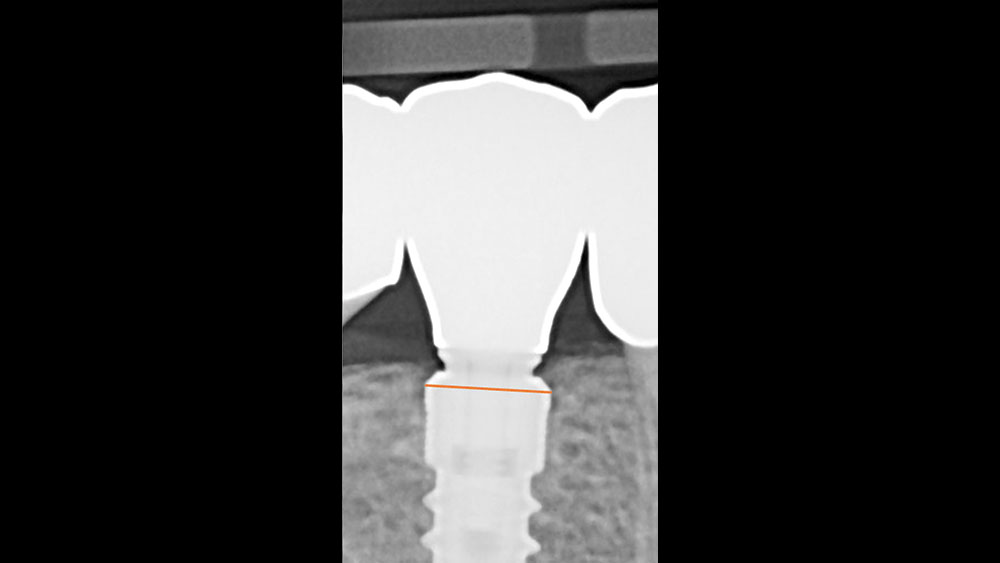 cm1401-rd-corner-efficacy-hahn-tapered-system-1b