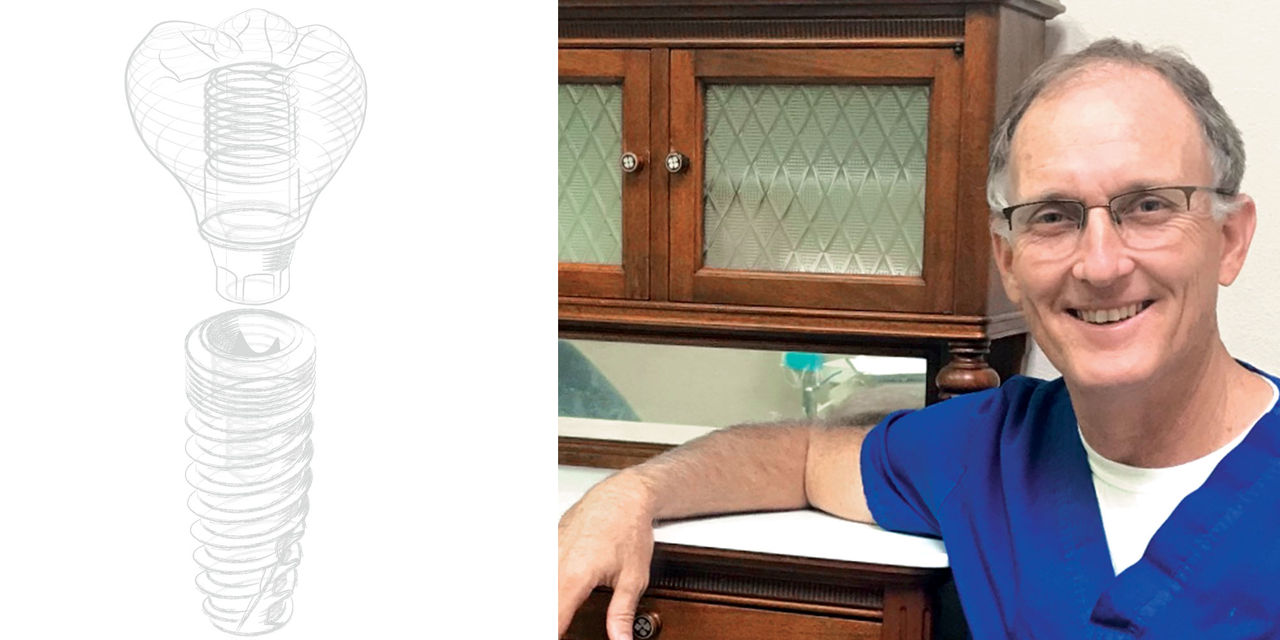 My First Hahn™ Tapered Implant with John A. Geasland, DDS