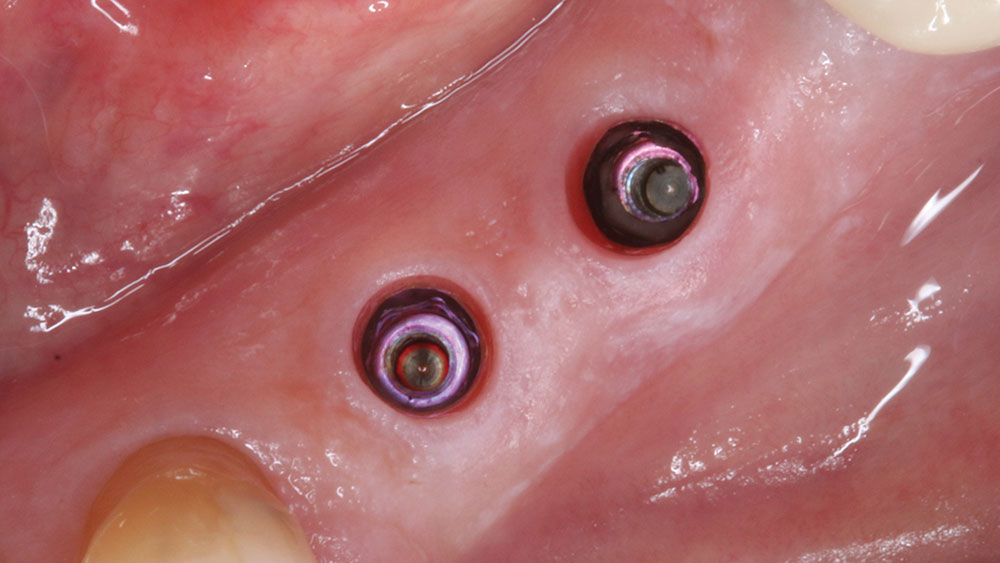 Hahn Tapered Implant surgical protocol