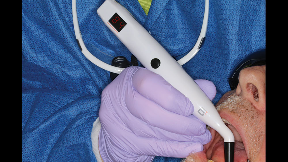 close-up of dr's hand measuring patient's ISQ