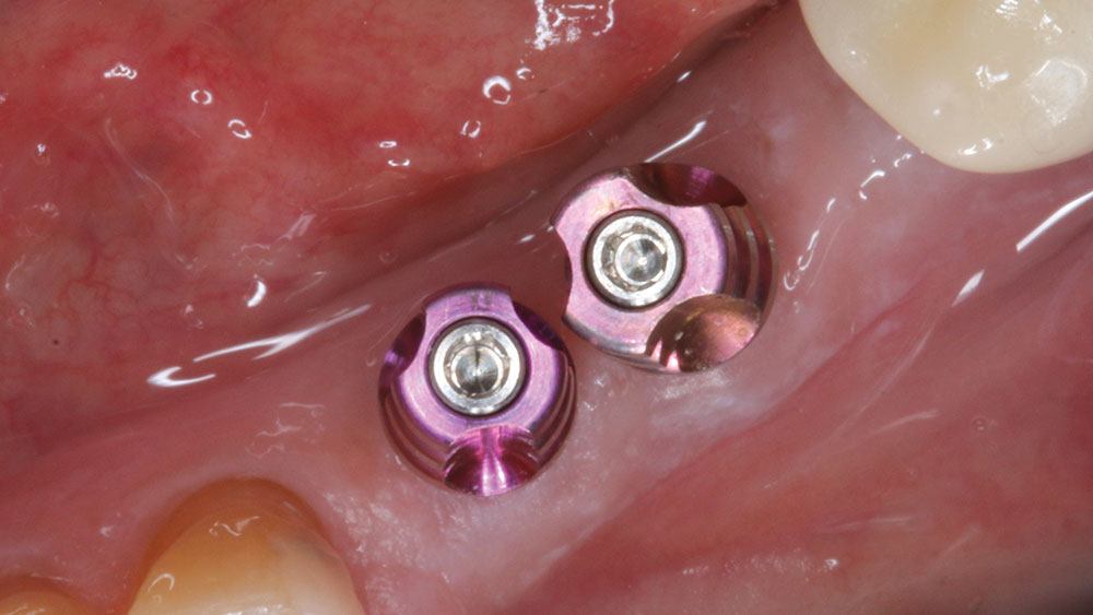 Impression copings are seated