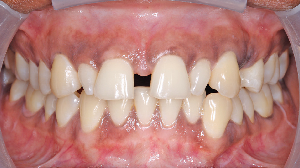 Renea's case prior to treatment