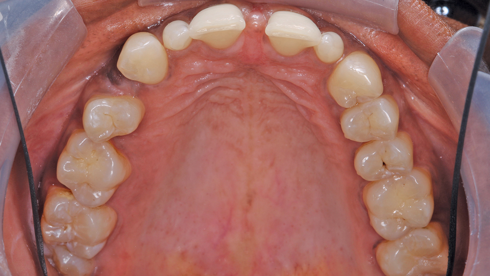 Required fixes for patient on tooth #4 and #5