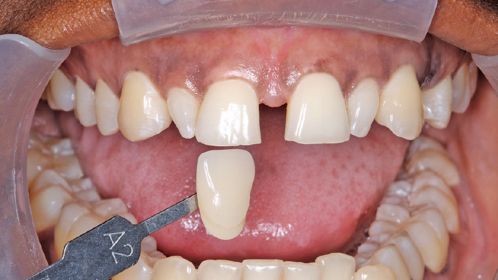 shade guide used to identify the current shade of Rennea’s teeth