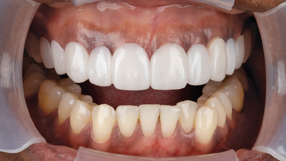 Smile Transitions appliance covers the entire upper arch