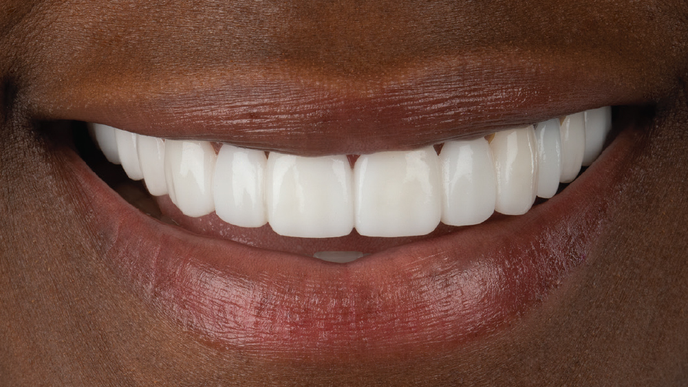 9 Vivaneer BruxZir Esthetic Veneers