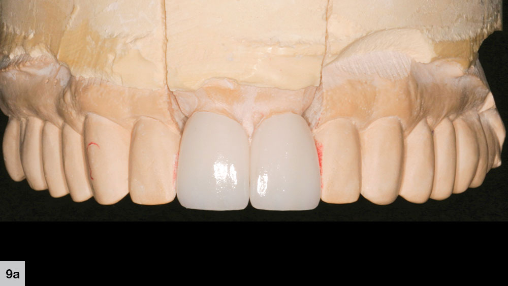 Obsidian lithium silicate restorations