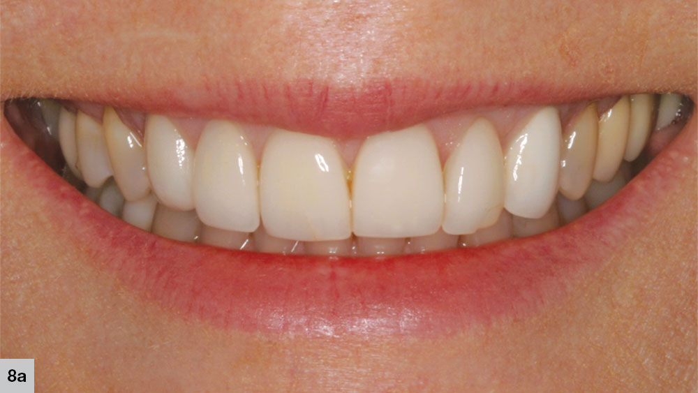 classic “Chiclet look” 