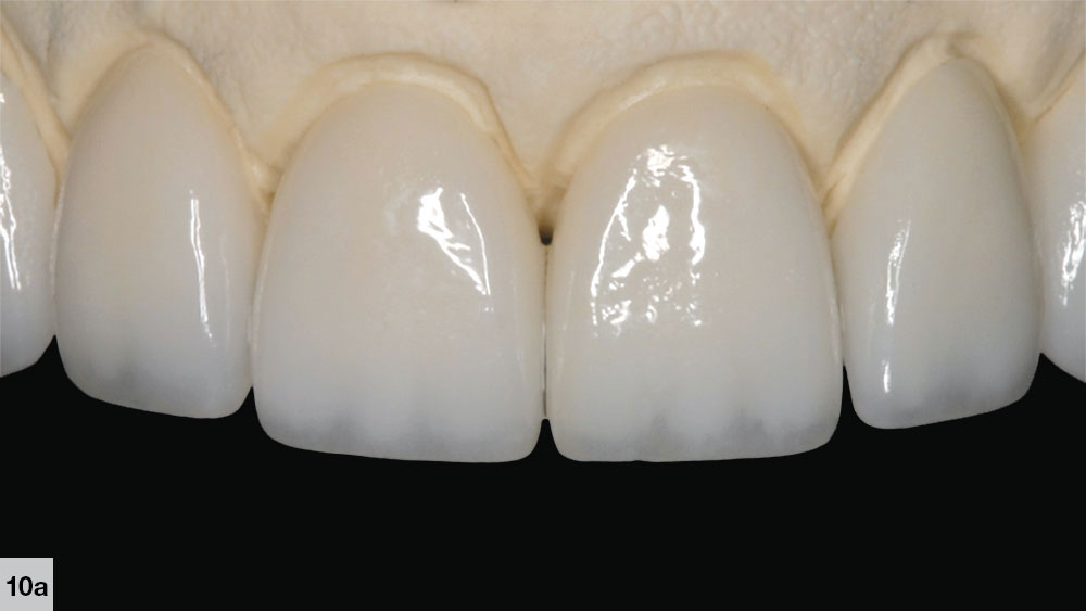 Overdone Incisal translucency