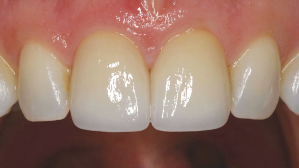 Slight irregularities that flow along the incisal edges of these restorations on teeth #8 & #9, resulting in lifelike esthetics