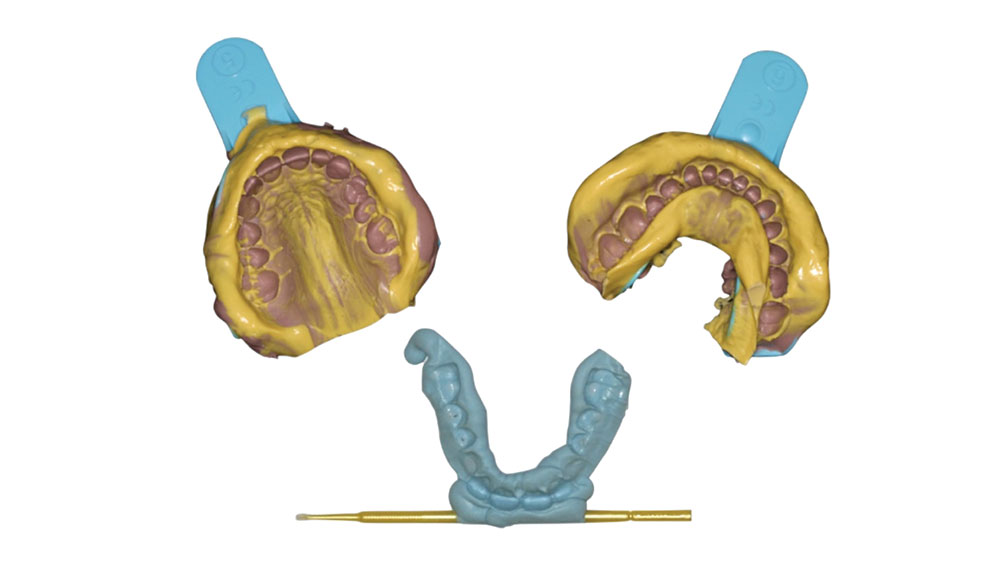 Capture Impression System for detailed impressions