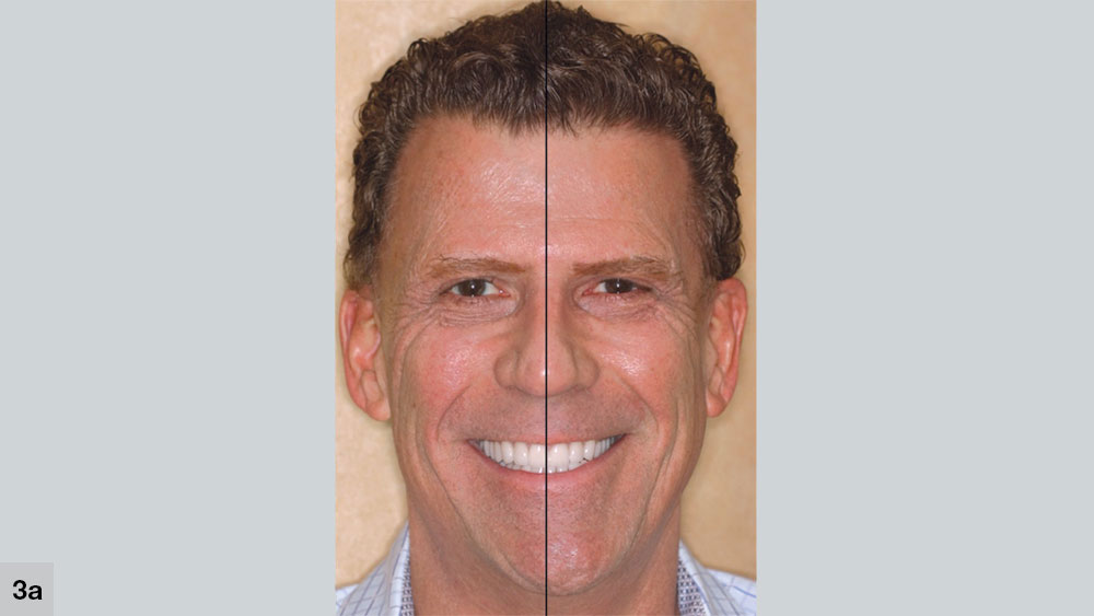 Parallel long axis of the face