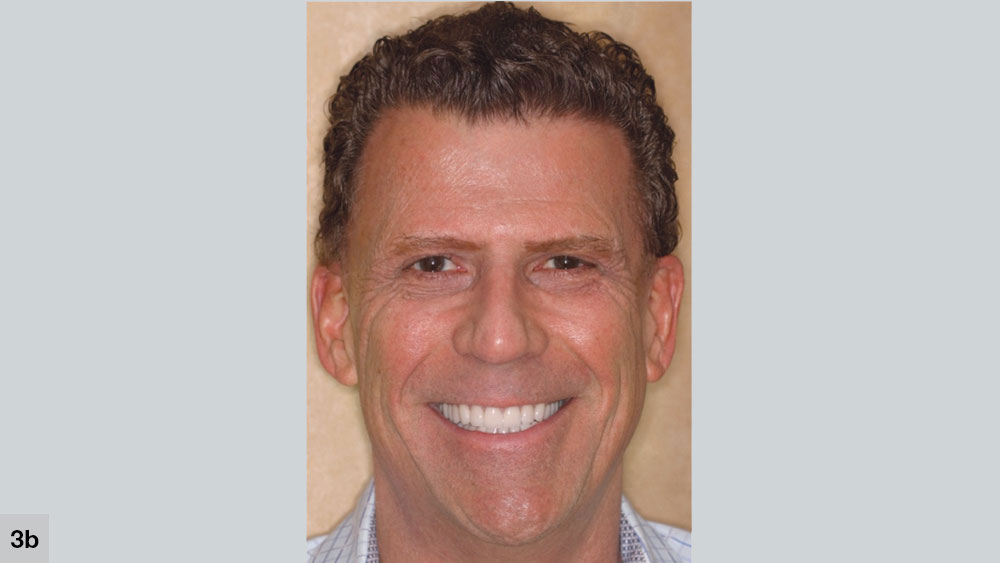 Midline does not align with the middle of the face of patient