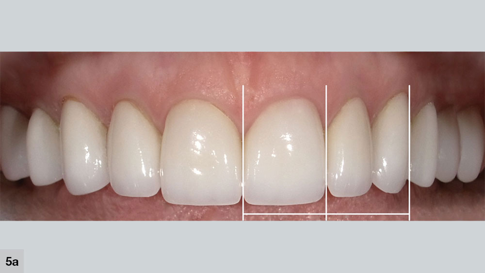 Golden Proportion principle says that the central incisor width should equal the combined width of the lateral incisor and canine when viewed from the front