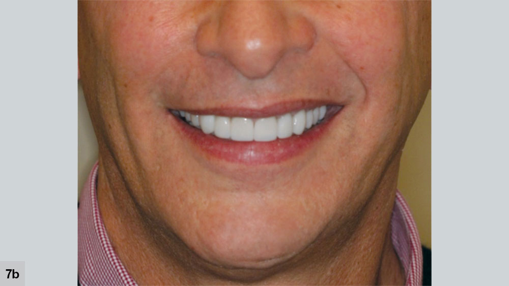 Smile that does not follow the lip contour