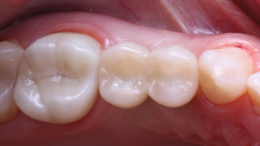 Final close-up of patient's implant restorations