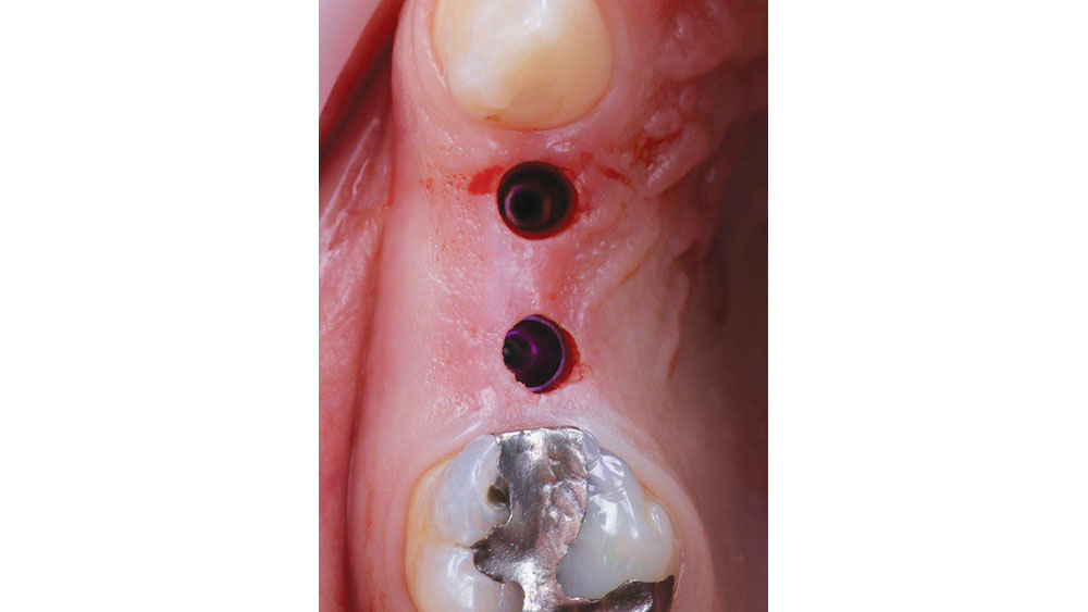 Removal of the surgical guide revealed the implants in place