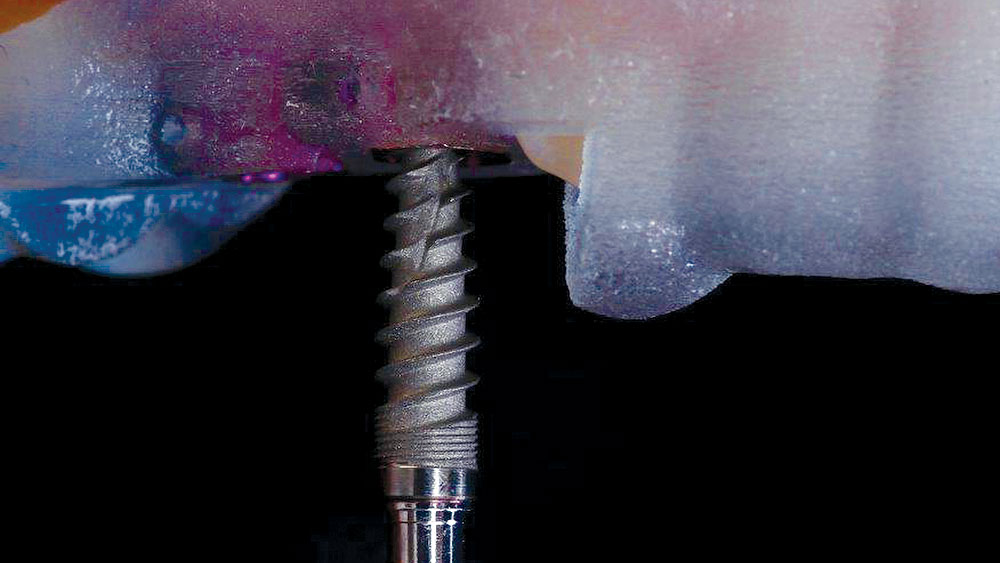 Close-up of implant mount tool