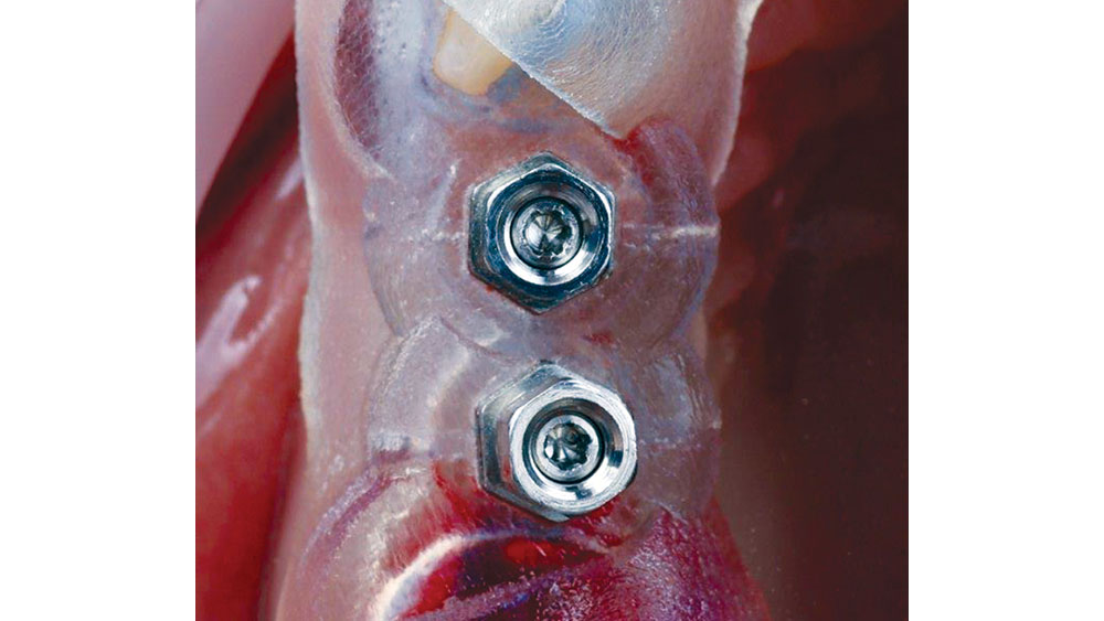 internal hexes of the implants are aligned with titantium sleeves of the surgical guide