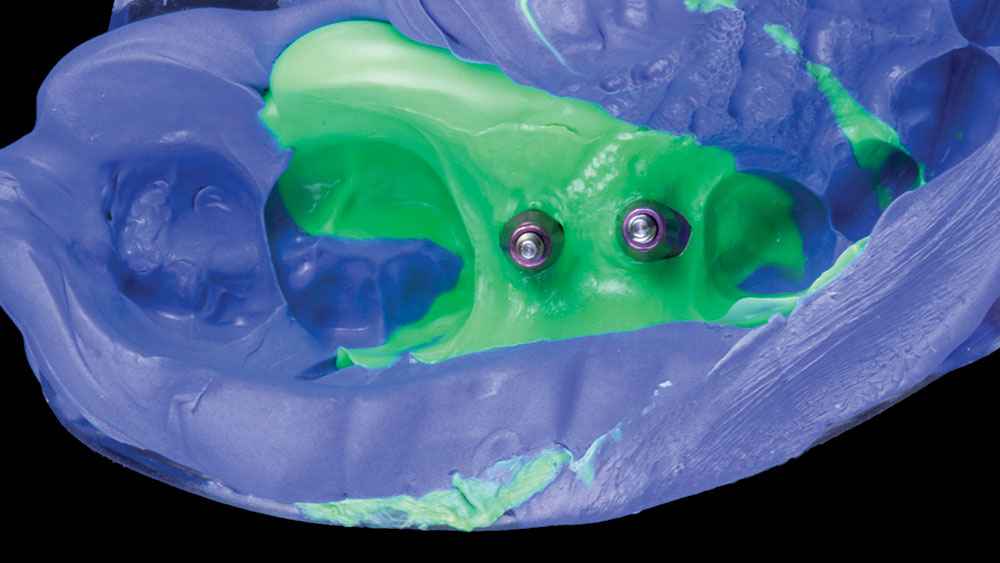 VPS impression is taken of implant site to create the restoration