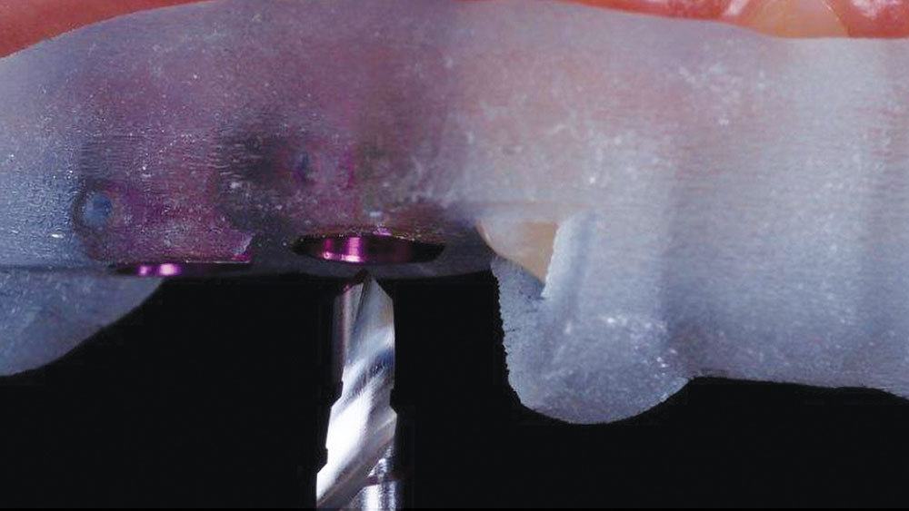 Osteotomies are deepened with a 3.5 mm pilot drill and then a shaping drill used to complete the process