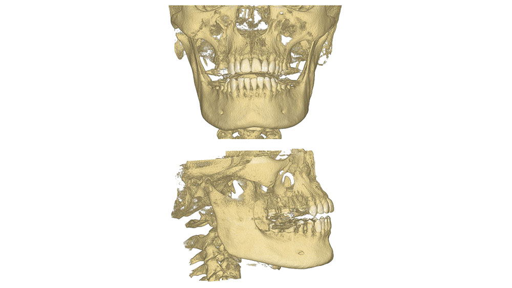 CBCT scan
