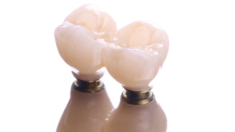 Close-up of two screw-retained restorations