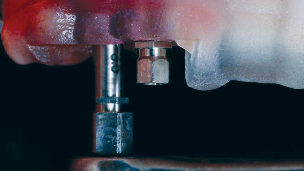 Close-up of mount wrench used to obtain proper alignment and tighten both implants