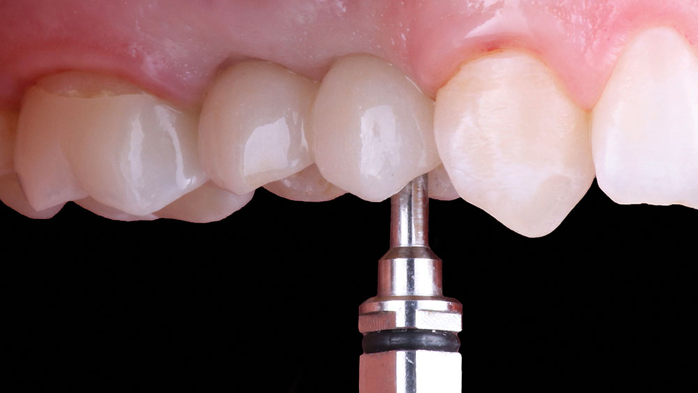 Prosthetic screws used to tighten the restorations