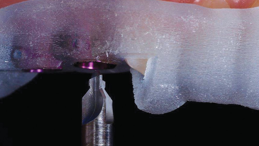 the alignment drill was used to create the initial osteotomy for the first of the two implants