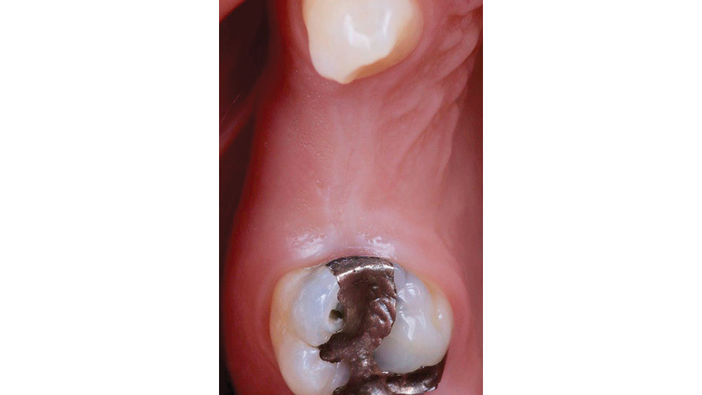 patient's missing teeth #4 and #5