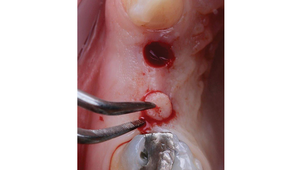 Flapless surgery procedure