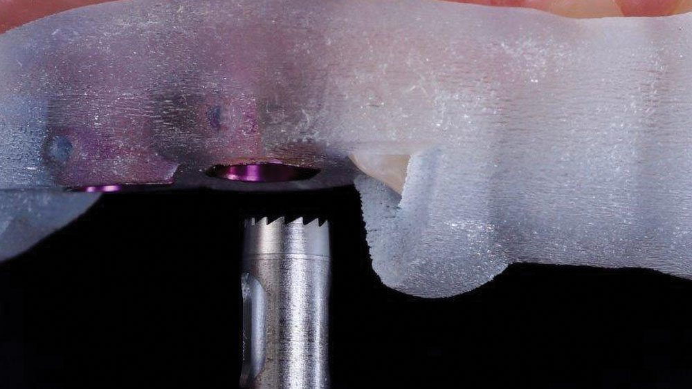 3.5 mm tissue punch from the Hahn Guided Surgical Kit was used to expose bone in the locations of teeth #4 & #5